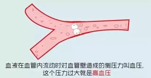 高血压.jpg